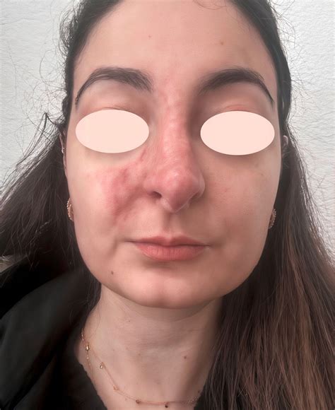 Gesichtsischämie und vaskuläre Komplikationen nach Filler-Injektion ...