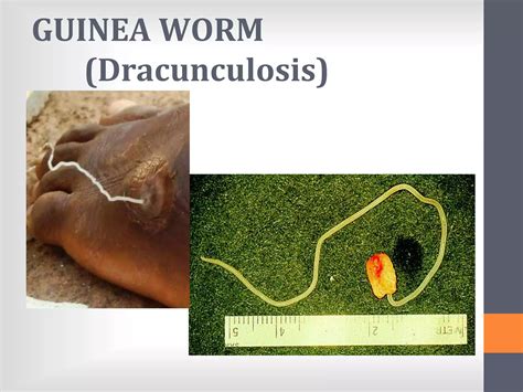 National guinea worm disease control programme | PPT
