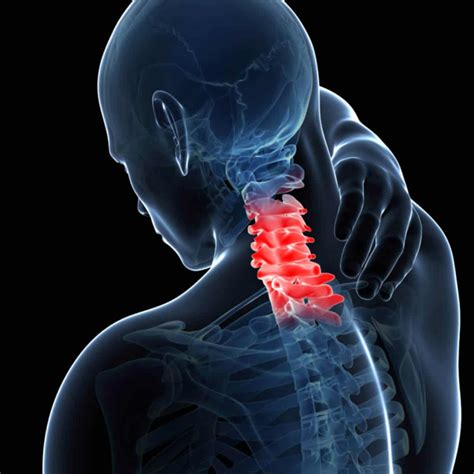 Whiplash Injury On Nerves