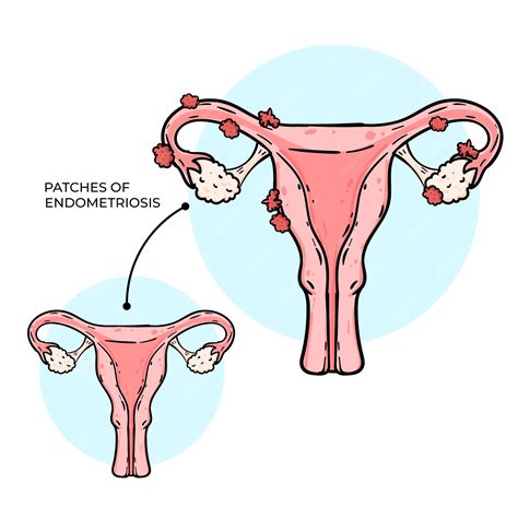 Ilustración de la endometriosis dibujada a mano | Vector Gratis