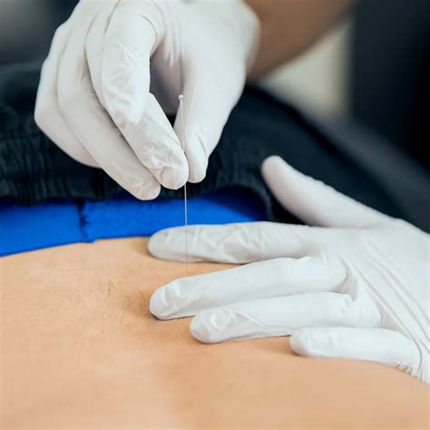 Certified Dry Needling Services in Falcon, CO - PhysioEdge Physical ...