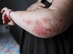 Image result for pustulosis