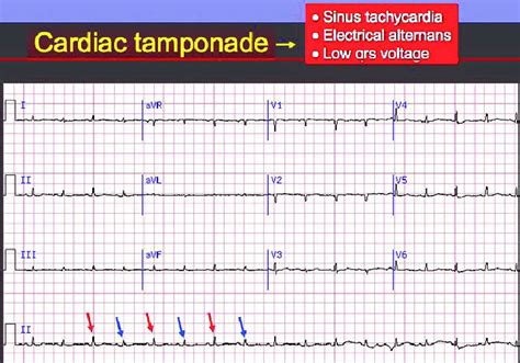 Cardiac tamponade causes, signs, symptoms, diagnosis and treatment