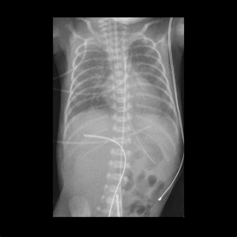 Umbilical Artery Catheter