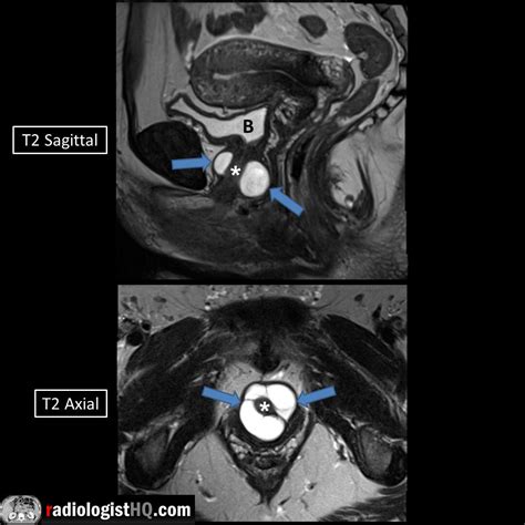 Urethral Diverticulum Mri