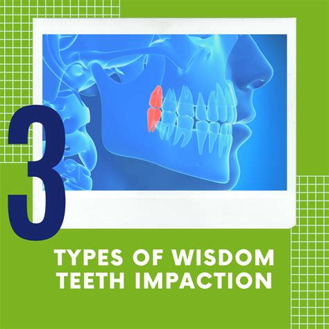 Impacted Wisdom Tooth Extraction