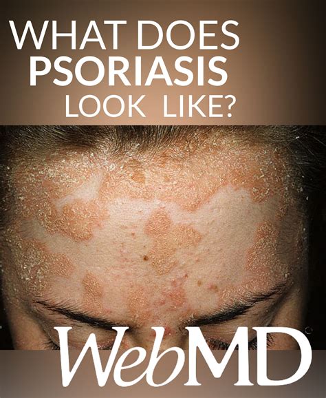 rash psoriasis