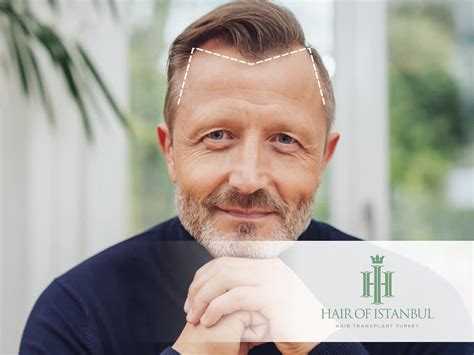 M-Shaped Hairline Causes and Effective Solutions