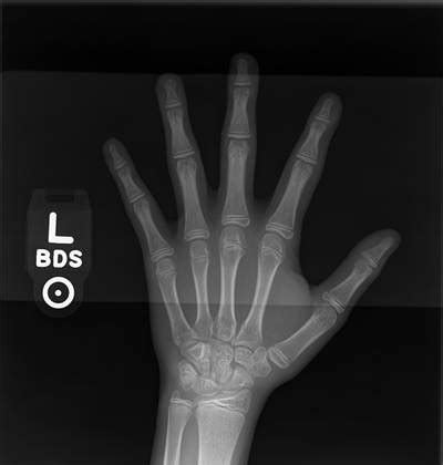 RSNA Bone Age 2017 - Dataset Ninja