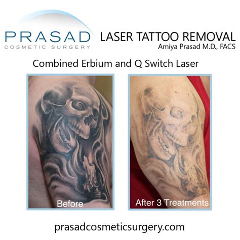 Does Tattoo Removal Hurt?