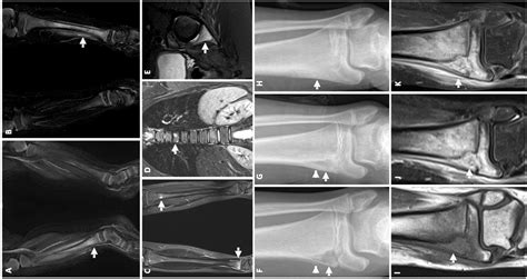 Chronic recurrent multifocal osteomyelitis: Keys to diagnosis | Anales de Pediatría