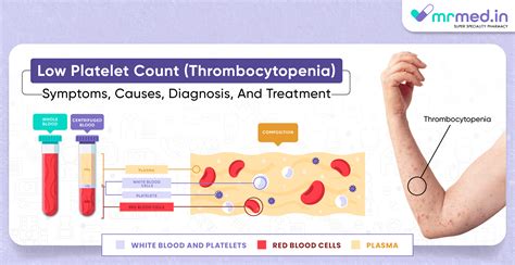 What Is Abnormal Platelet Count at Dale Mack blog