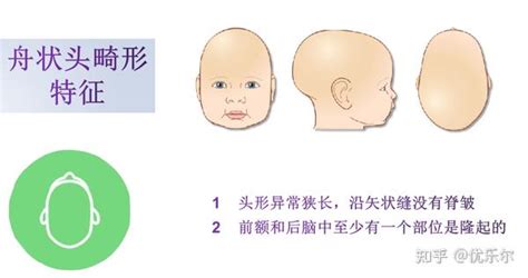 宝宝的头变畸形了？也许是患上了狭颅症-刘星宇的博客-KQ88口腔博客