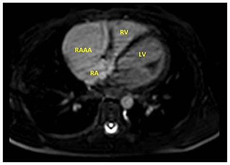 A Gigantic Congenital Right Atrial Appendage Aneurysm in an Infant: Ten ...