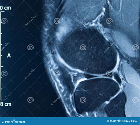 Knee injury mri mcl tear stock image. Image of injury - 154117367