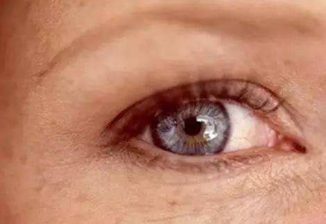 眼睛周围长斑怎么办（眼角长斑是什么引起的 六大因素导致眼角长斑） | 说明书网