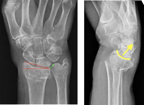 A Patient’s Guide to Distal Radius Fractures — Dr. Nick Golinvaux