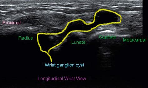Wrist Ganglion Cysts _ PATIENT EDUCATION RESOURCE Ganglion Cyst – FUERTS