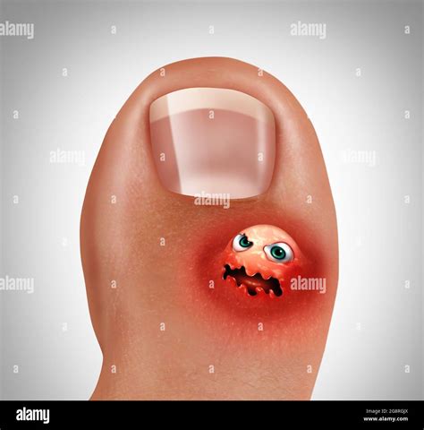 Blister foot hi-res stock photography and images - Alamy