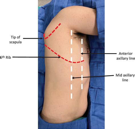 Anterior Axillary Line