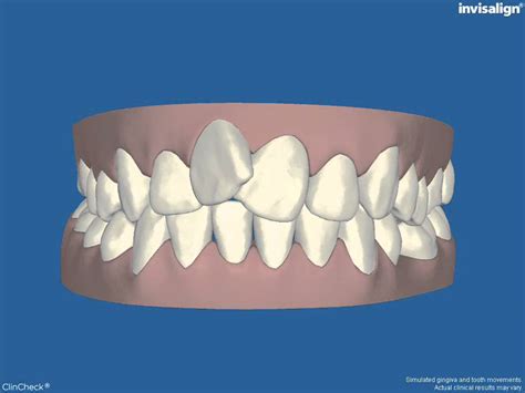 Image result for Invisalign ClinCheck