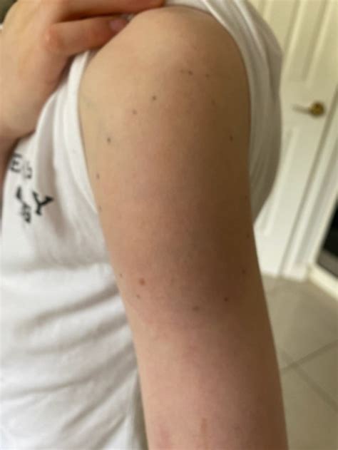 Image result for Injection Reactions