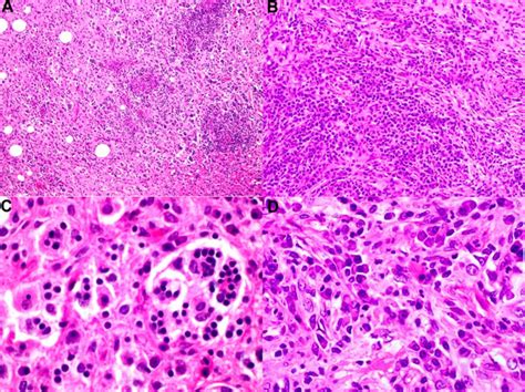 Rosai-Dorfman disease, causes, symptoms, diagnosis, treatment & prognosis