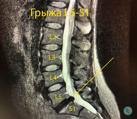 Поясничная грыжа на уровне L5-S1