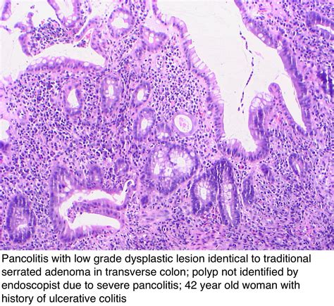 Pathology Outlines - Dysplasia