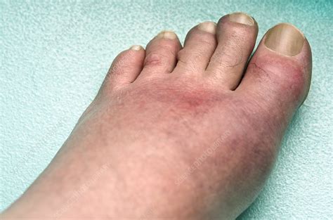 Gout affecting the foot - Stock Image - C007/0828 - Science Photo Library