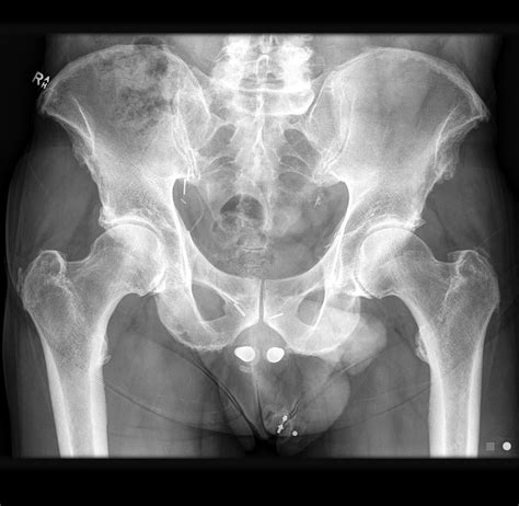Normal xray hip - leadingfeet