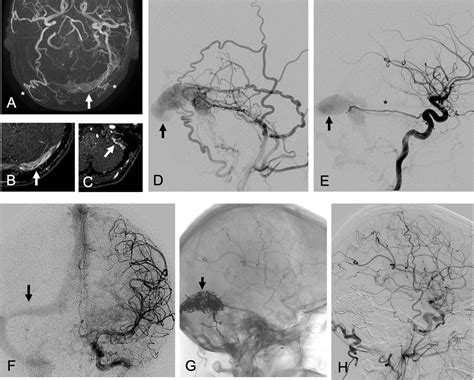 Management of vascular causes of pulsatile tinnitus | Journal of NeuroInterventional Surgery