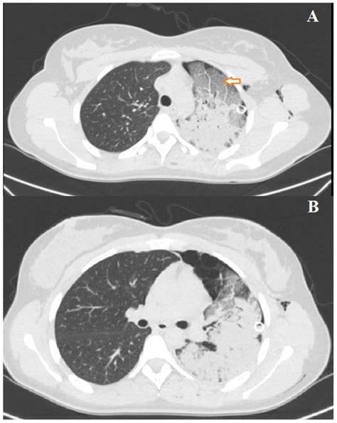 Re-Expansion Pulmonary Edema as a Life-Threatening Complication in ...