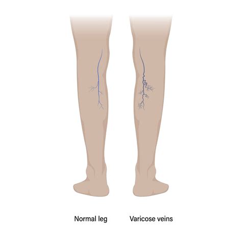 Spider Veins And Varicose Veins | The Surgical Clinic