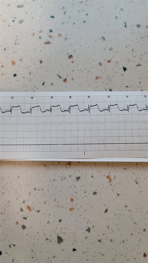 Image result for Telemetry Practice