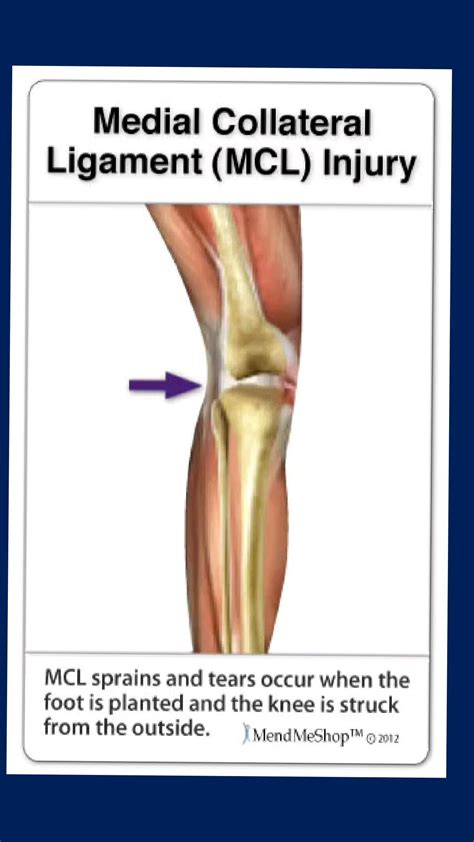 Pes anserine bursitis is also known as goosefoot bursitis – Artofit