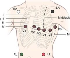 Image result for Lead Optimization Mapper Algorithm