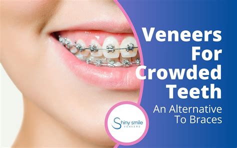 Veneers For Crowded Teeth | An Alternative To Braces | Shiny Smile Veneers