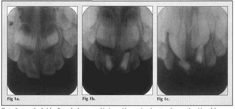 Pulpectomy treatment of choice for necrotic primary molars compared to ...