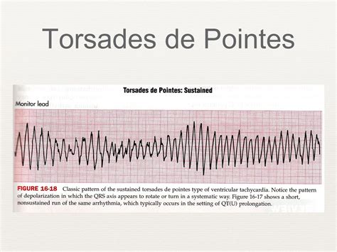 ECG Interpretation Criteria Review - ppt video online download