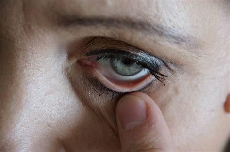 White Dots In Eyes In Photos at Amy Kent blog