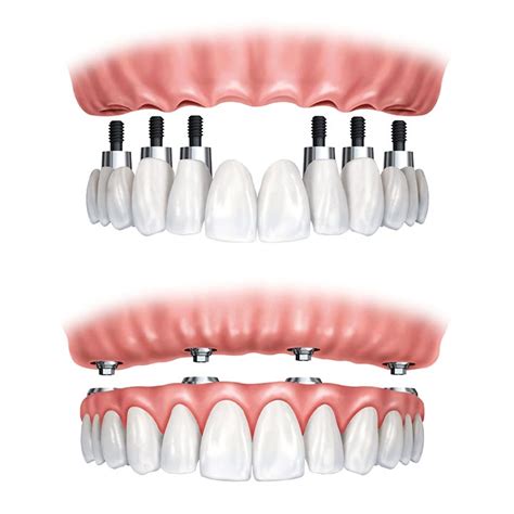 Implantes dentales All on Four Madrid |Precios, Opiniones, Antes ...