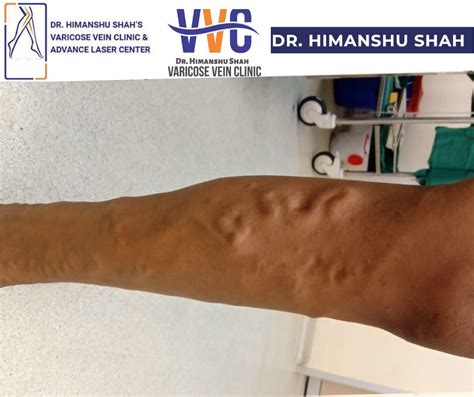 Varicose Vein Treatment Mumbai | Dr Himanshu Shah