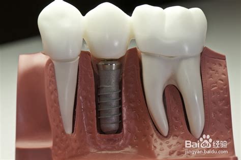 单颗门牙缺失的种植牙修复案例，上海代梦口腔