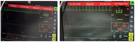 Sinus Tachycardia Following Administration of Naloxone in a Dog[v1 ...