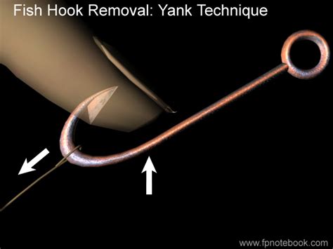 Image result for String Yank Method