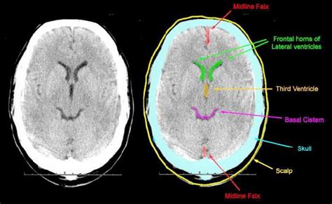 Image result for Normal Brain CT Scan