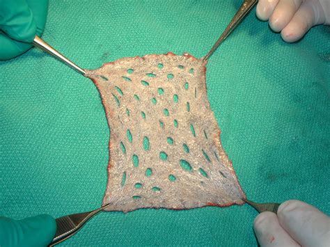 Reconstruction - Skin Graft — DR. JULIUS M. LIPTAK