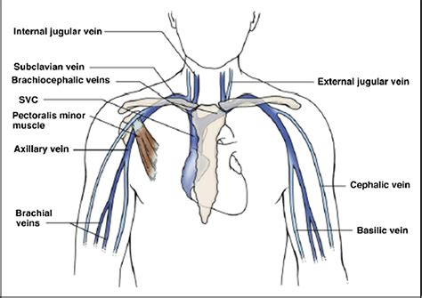 Upper-extremity Deep Venous Thrombosis: A Review - The American Journal of Medicine