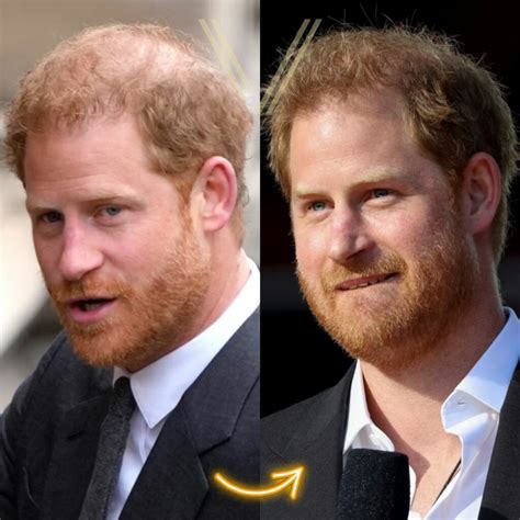 Prince Harry Hair Transplant: Before and After Transformation